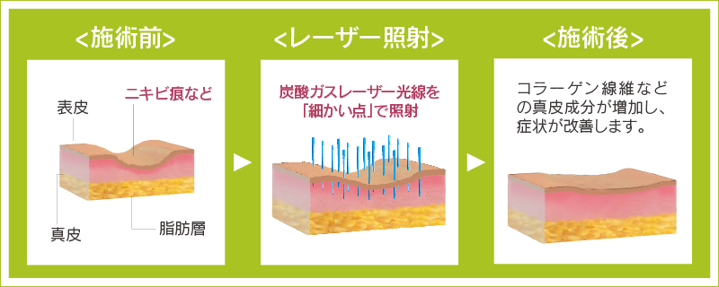 フラクショナルレーザー治療イメージ