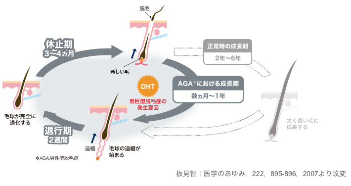 AGAの病態