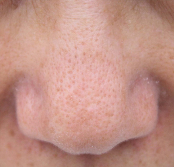 鼻の毛穴の開き：治療前