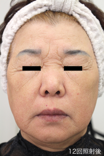 レーザーフェイシャル１２回完了　After LaserFacial 12 Treatment-2