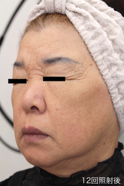 レーザーフェイシャル１２回完了　After LaserFacial 12 Treatment-4