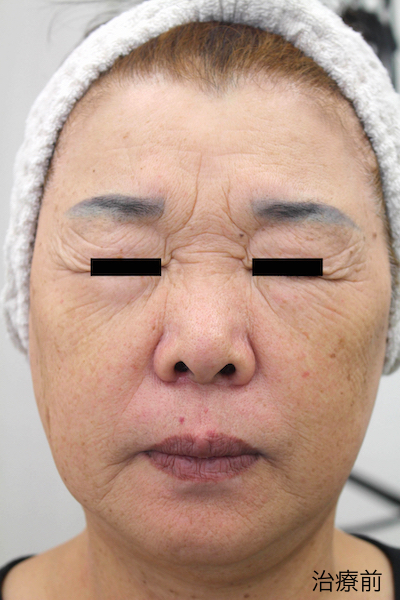 レーザーフェイシャル１２回完了　After LaserFacial 12 Treatment-1