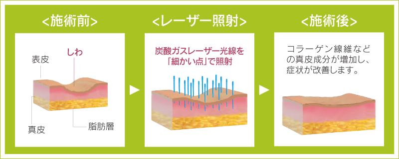 フラクショナルレーザーによるしわの改善