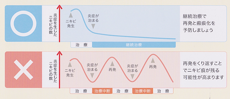 ニキビの再発予防2