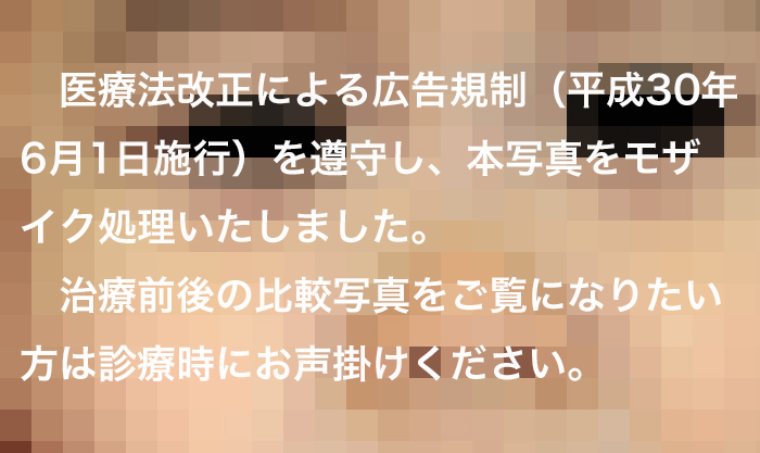 生まれつき（先天性）のほくろに対する冷凍療法（液体窒素）2