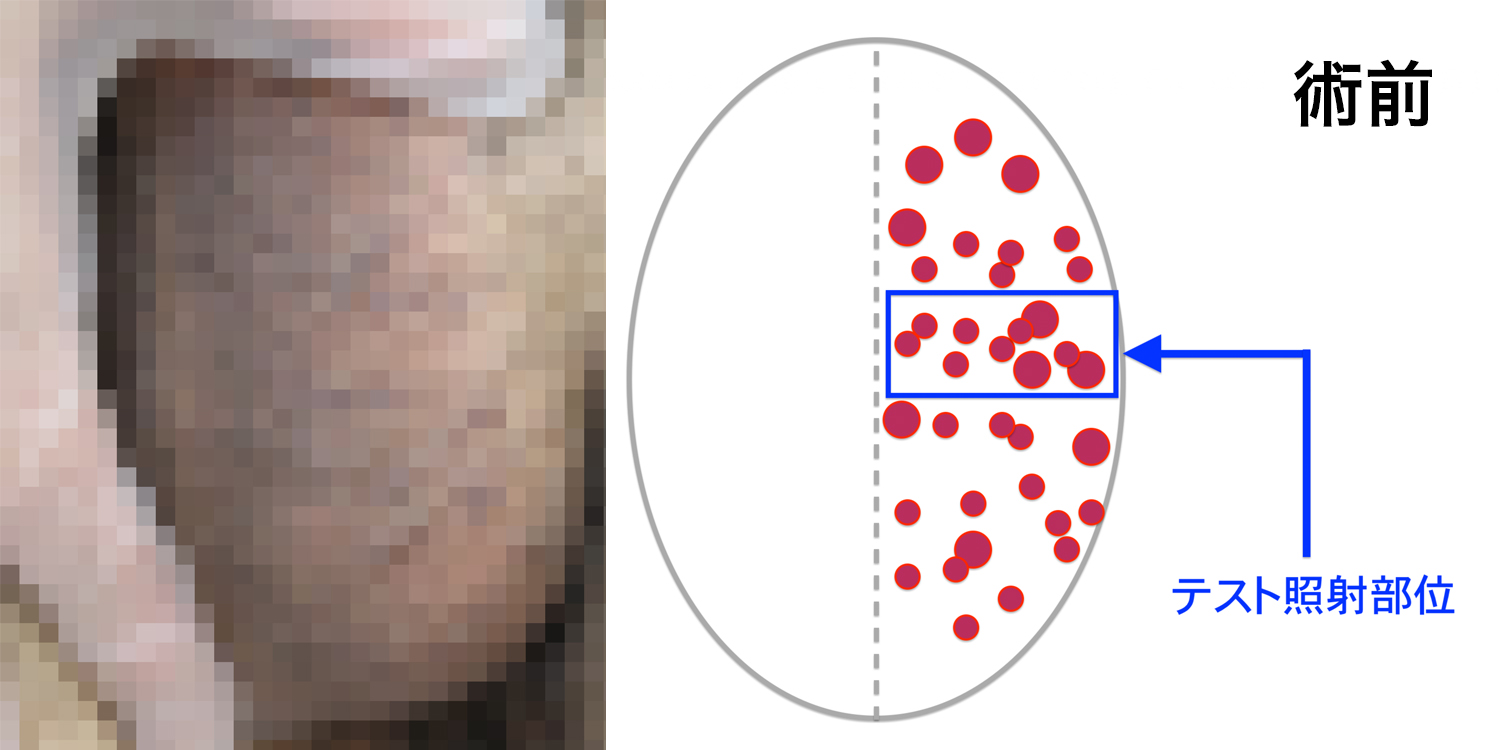 被角血管腫のBefore-After-1