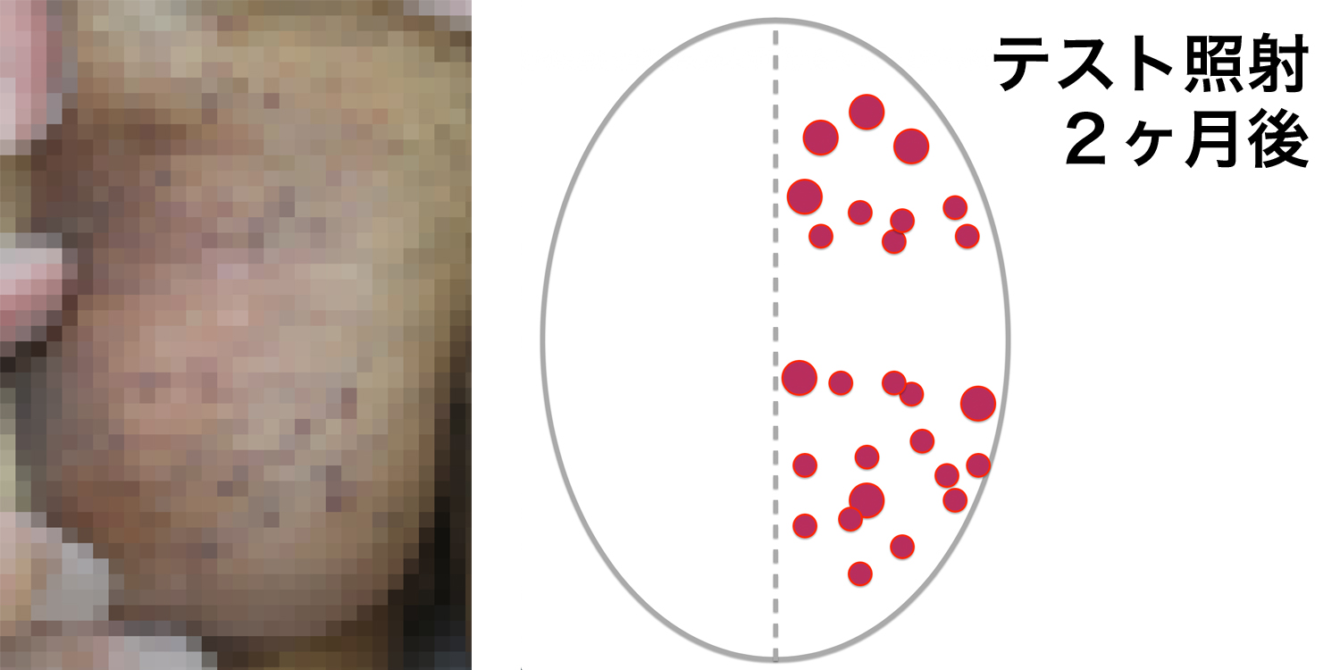 被角血管腫のBefore-After-2