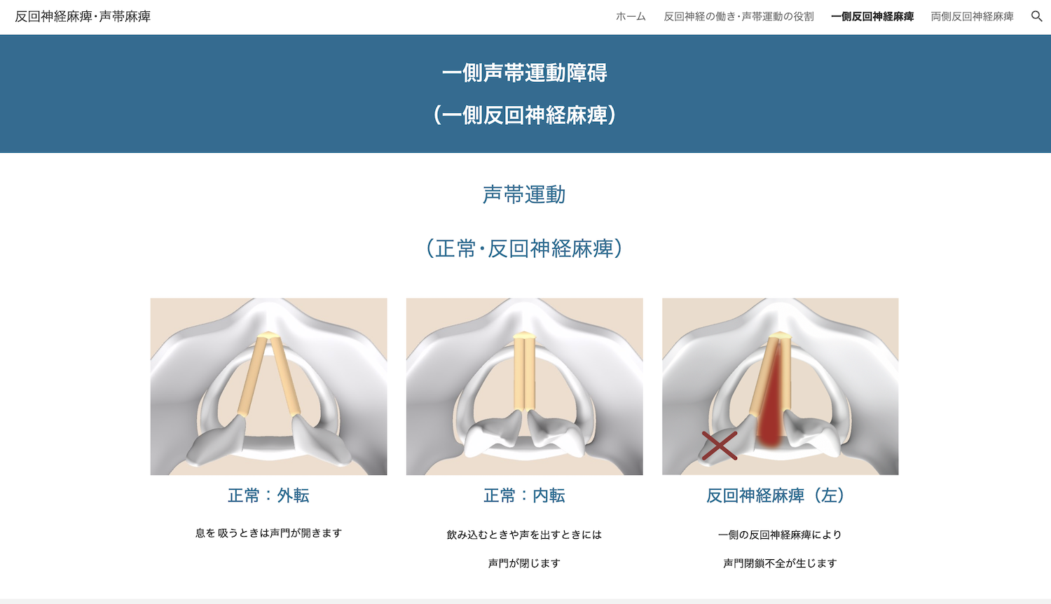 反回神経麻痺外来3